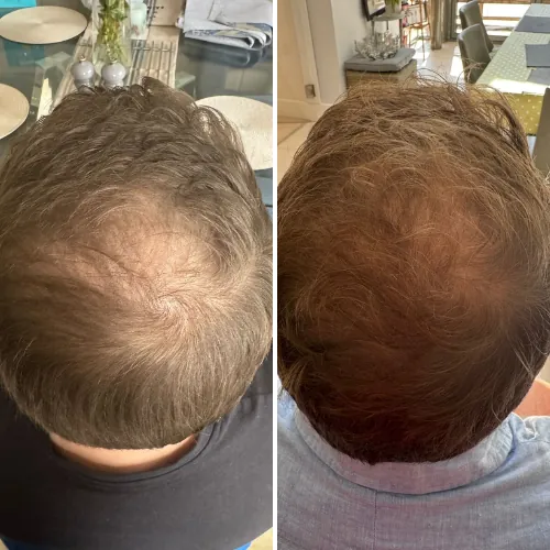 Before and after result