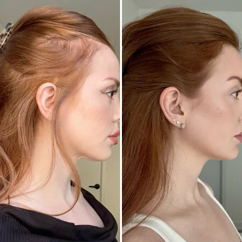 Before and after result