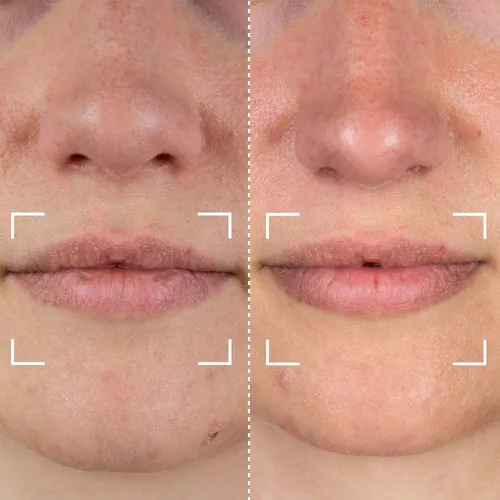 Before and after result