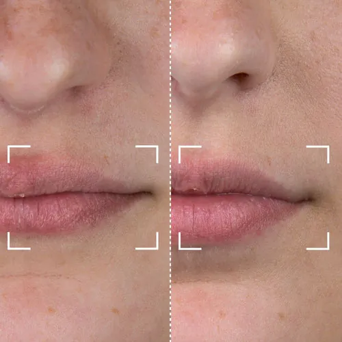 Before and after result