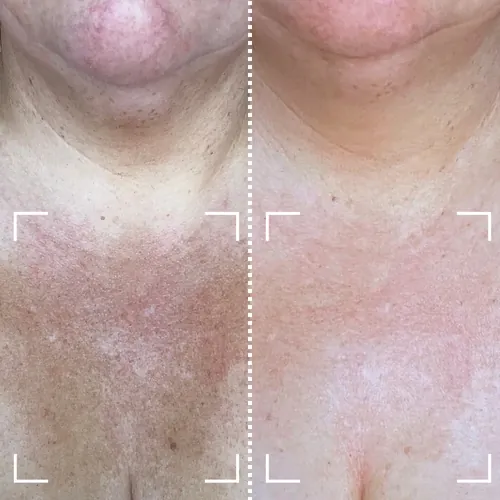 Before and after result