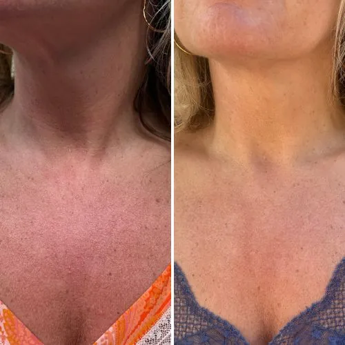 Before and after result