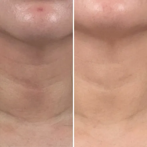 Before and after result