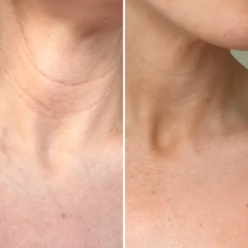 Before and after result