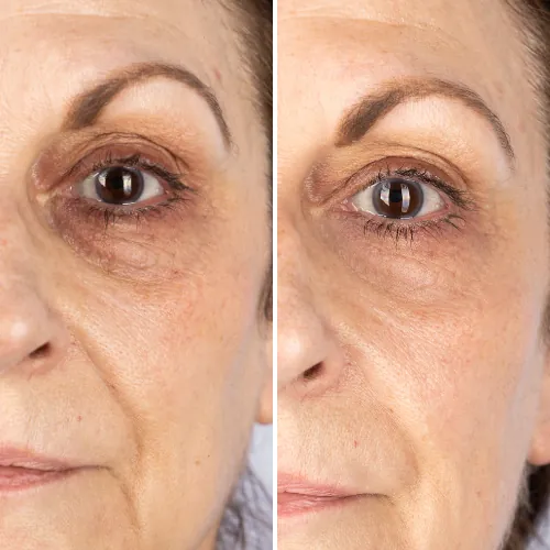 Before and after result