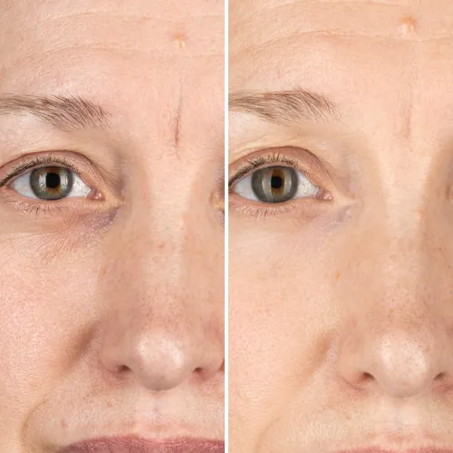 Before and after result