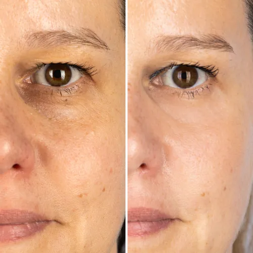 Before and after result