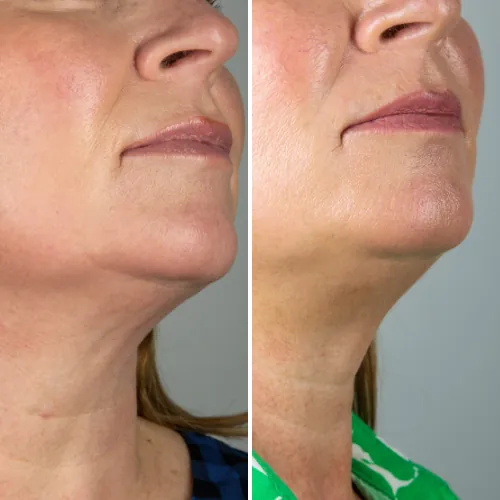 Before and after result