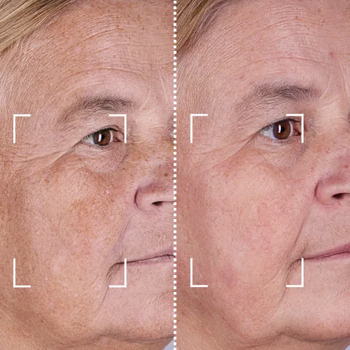 Before and after result